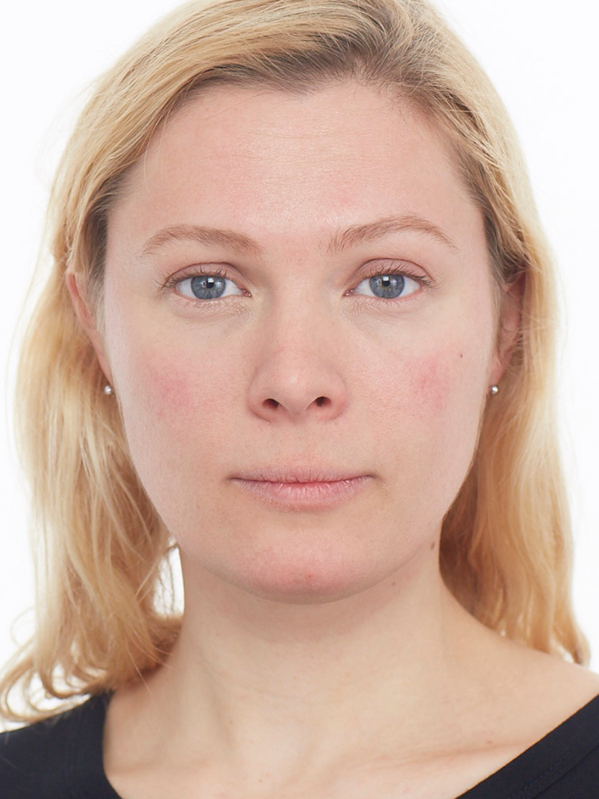 Hvad er rosacea?